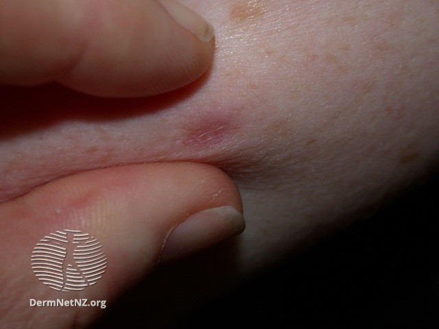 File:Pinch sign of dermatofibroma (DermNet NZ lesions-df4).jpg