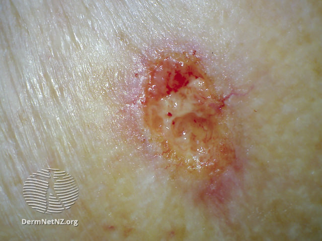 File:Ulcerating basal cell carcinoma, arm (DermNet NZ ubcc-arm-18-dn).jpg