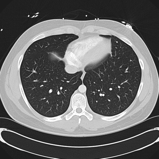 File:'Bovine' aortic arch (Radiopaedia 33554-34637 Axial lung window 45).png