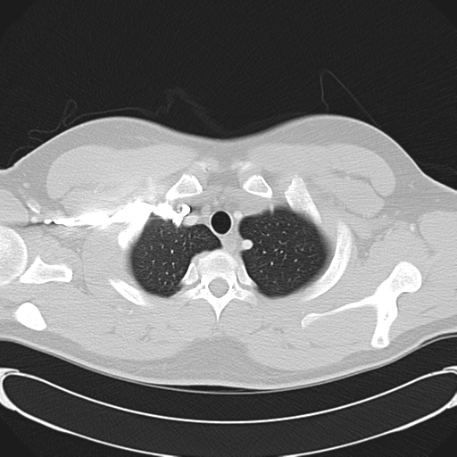 'Bovine' aortic arch (Radiopaedia 33554-34637 Axial lung window 9).png