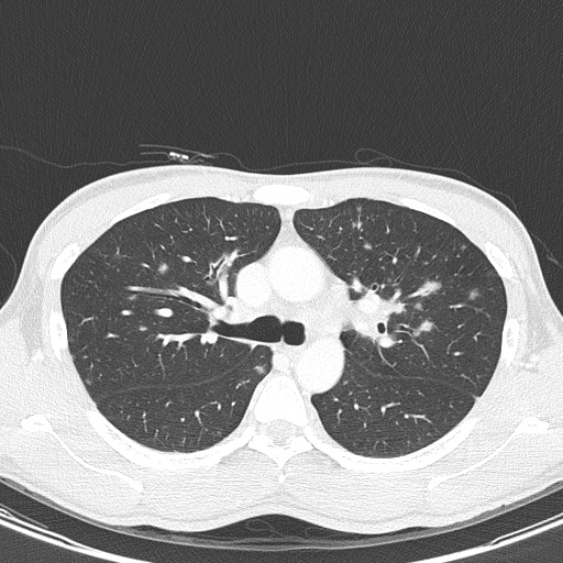 AIDS-related Kaposi sarcoma (Radiopaedia 85247-100811 Axial lung window 58).jpg