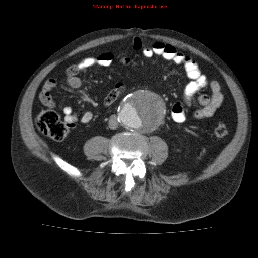 File:Abdominal aortic aneurysm (Radiopaedia 10122-10660 Axial C+ portal venous phase 47).jpg