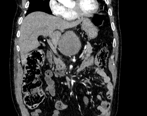 Abdominal aortic aneurysm (Radiopaedia 67117-76452 Coronal C+ arterial phase 25).jpg