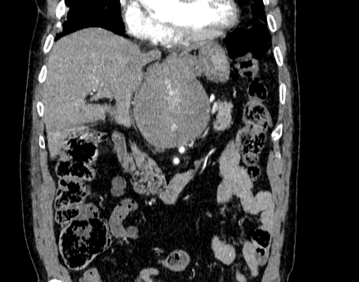 File:Abdominal aortic aneurysm (Radiopaedia 67117-76452 Coronal C+ arterial phase 33).jpg