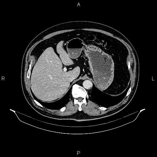 Abdominal aortic aneurysm (Radiopaedia 83094-97462 Axial renal cortical phase 74).jpg