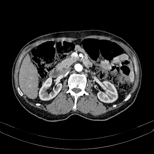 Abdominal aortic aneurysm (Radiopaedia 83581-98689 Axial C+ arterial phase 50).jpg