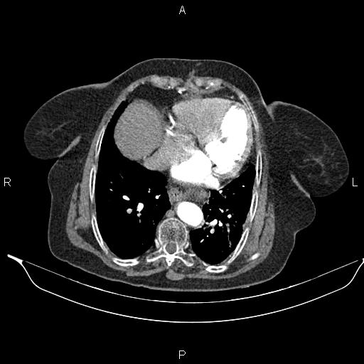 File:Abdominal aortic aneurysm (Radiopaedia 85063-100606 Axial C+ arterial phase 23).jpg