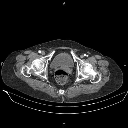 File:Abdominal aortic aneurysm (Radiopaedia 85063-100606 Axial C+ arterial phase 63).jpg