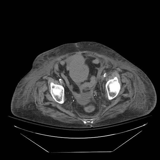 Abdominal aortic aneurysm - impending rupture (Radiopaedia 19233-19247 Axial non-contrast 145).jpg