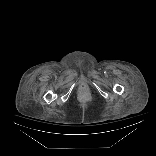 Abdominal aortic aneurysm - impending rupture (Radiopaedia 19233-19247 Axial non-contrast 178).jpg