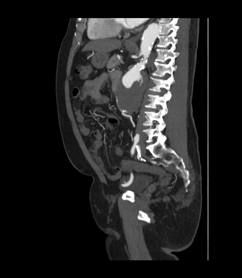 Abdominal aortic aneurysm with thrombus fissuration (Radiopaedia 46218-50618 Sagittal C+ arterial phase 35).jpg