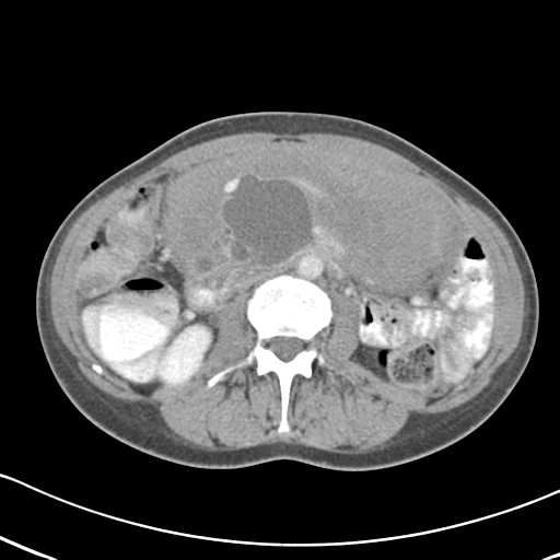 Abdominal desmoid tumor (Radiopaedia 41007-43740 Axial C+ portal venous phase 31).png