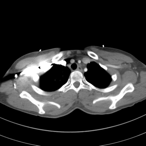 File:Abdominal multi-trauma - devascularised kidney and liver, spleen and pancreatic lacerations (Radiopaedia 34984-36486 Axial C+ arterial phase 17).png