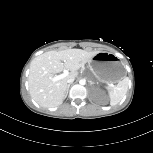 File:Abdominal multi-trauma - devascularised kidney and liver, spleen and pancreatic lacerations (Radiopaedia 34984-36486 Axial C+ portal venous phase 19).png