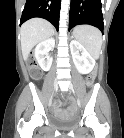 File:Abdominal tuberculosis and appendicitis (Radiopaedia 65631-74735 Coronal C+ portal venous phase 30).png