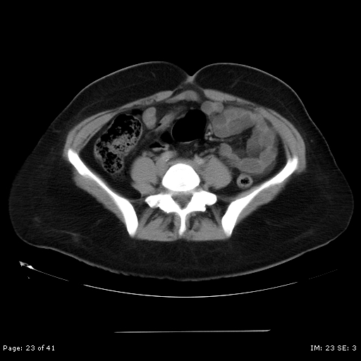 File:Abdominal wall endometriosis (Radiopaedia 25723-25885 Axial C+ portal venous phase 23).jpg