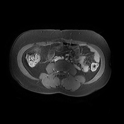 File:Abdominal wall endometriosis (Radiopaedia 83702-98847 Axial T1 C+ fat sat 8).jpg