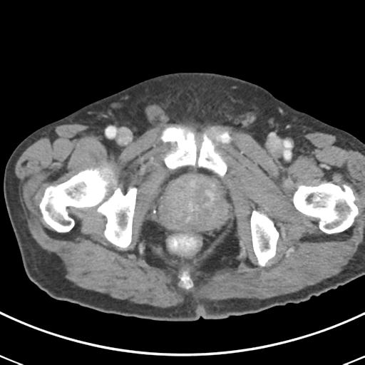 Abdominal wall metastasis from colorectal carcinoma (Radiopaedia 31016-31717 Axial C+ portal venous phase 77).jpg