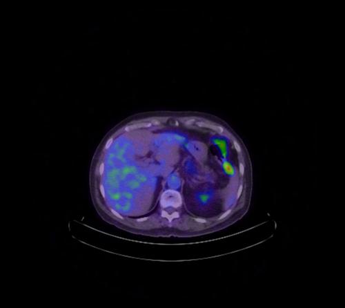 Abdominal wall metastasis from colorectal carcinoma (Radiopaedia 31016-31719 Axial 85).jpg