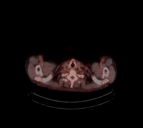 Abdominal wall metastasis from colorectal carcinoma (Radiopaedia 31016-31719 C 131).jpg
