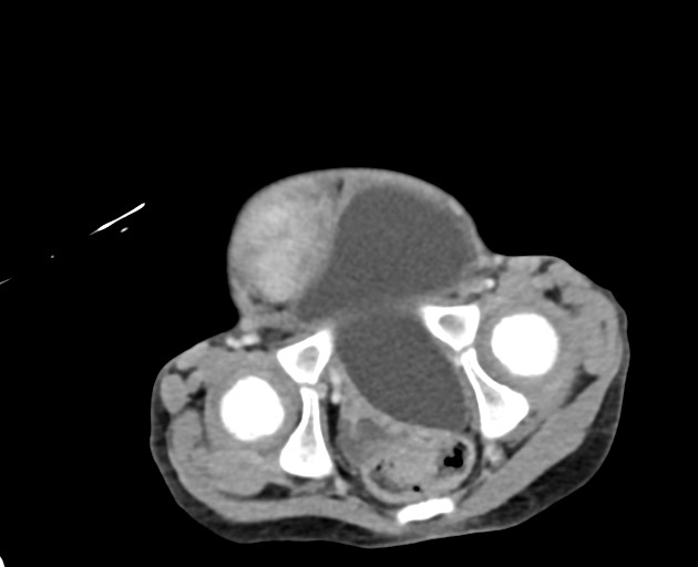 File:Abdominopelvic rhabdomyosarcoma (Radiopaedia 78356-90984 Axial C+ portal venous phase 147).jpg