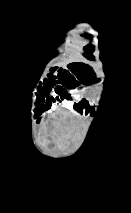 Abdominopelvic rhabdomyosarcoma (Radiopaedia 78356-90984 Coronal C+ portal venous phase 10).jpg