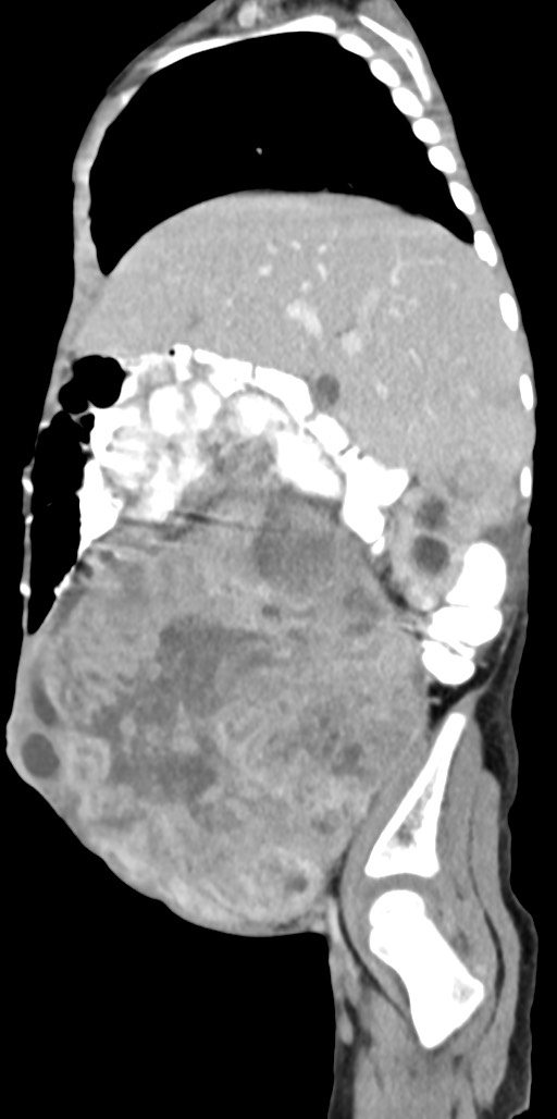 Abdominopelvic rhabdomyosarcoma (Radiopaedia 78356-90984 Sagittal C+ portal venous phase 70).jpg
