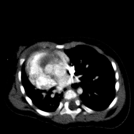 Aberrant left pulmonary artery (pulmonary sling) (Radiopaedia 42323-45435 Axial C+ CTPA 27).jpg