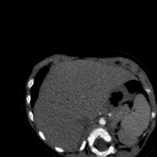 File:Aberrant left pulmonary artery (pulmonary sling) (Radiopaedia 42323-45435 Axial C+ CTPA 46).jpg
