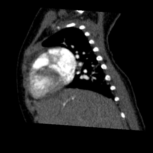 File:Aberrant left pulmonary artery (pulmonary sling) (Radiopaedia 42323-45435 Sagittal C+ arterial phase 16).jpg