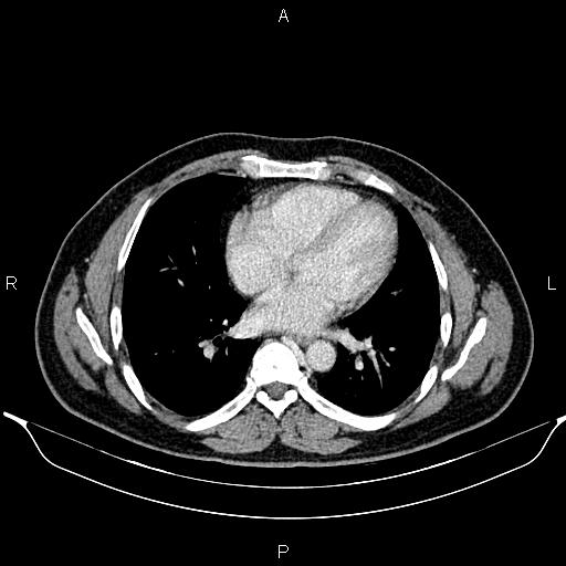 File:Aberrant right subclavian artery (Radiopaedia 87093-103354 Axial With contrast 69).jpg