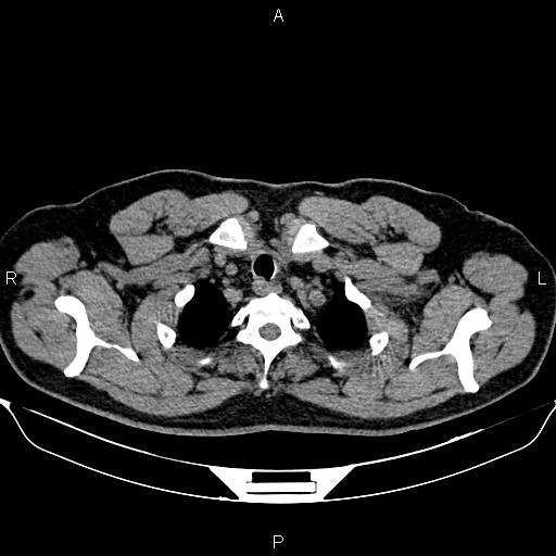Aberrant right subclavian artery (Radiopaedia 87093-103354 Axial non-contrast 11).jpg