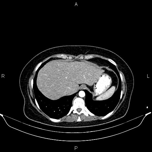File:Aberrant right subclavian artery (Radiopaedia 87334-103629 Axial C+ arterial phase 55).jpg