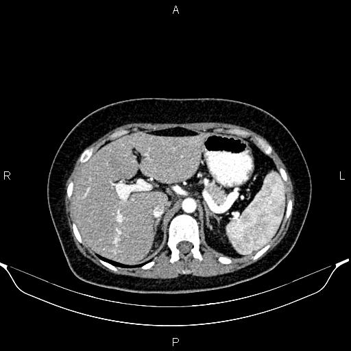 Aberrant right subclavian artery (Radiopaedia 87334-103629 Axial C+ arterial phase 68).jpg