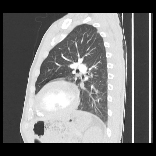 Accessory left horizontal fissure with lingular pneumonia (Radiopaedia 53763-59843 Sagittal lung window 46).jpg