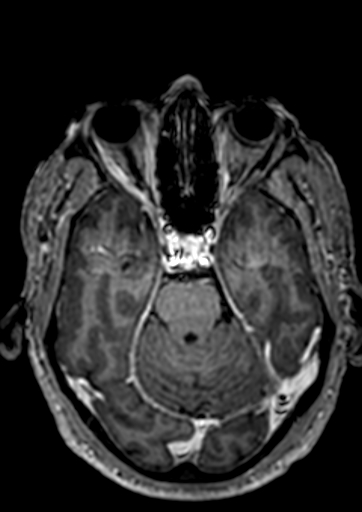 File:Accessory middle cerebral artery (Radiopaedia 73114-83828 Axial T1 C+ 97).jpg