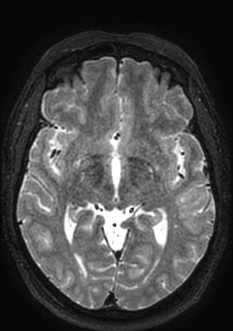 File:Accessory middle cerebral artery (Radiopaedia 73114-83828 Axial T2 90).jpg