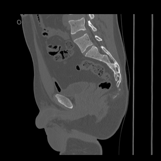 Acetabular and ilial fractures (Radiopaedia 59084-66378 Sagittal bone window 49).jpg