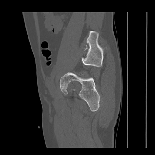 Acetabular and ilial fractures (Radiopaedia 59084-66378 Sagittal bone window 70).jpg