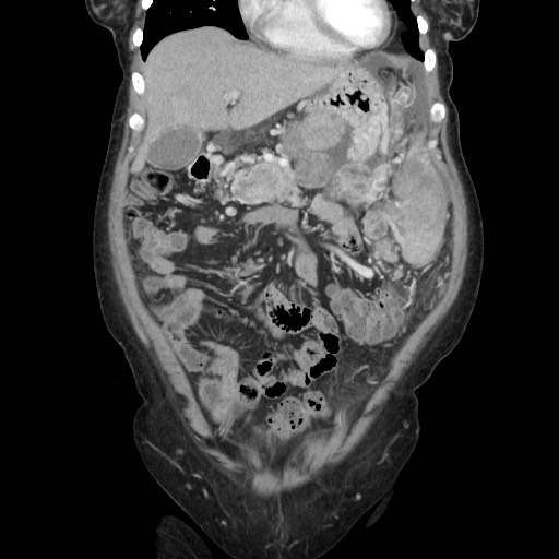 Acinar cell carcinoma of the pancreas (Radiopaedia 75442-86669 Coronal C+ portal venous phase 37).jpg