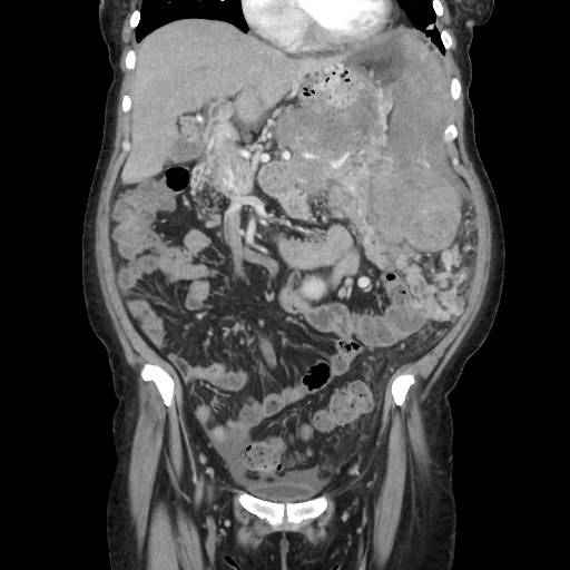Acinar cell carcinoma of the pancreas (Radiopaedia 75442-86669 Coronal C+ portal venous phase 47).jpg