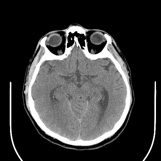File:Acoustic schwannoma (Radiopaedia 39170-41388 Axial non-contrast 21).png