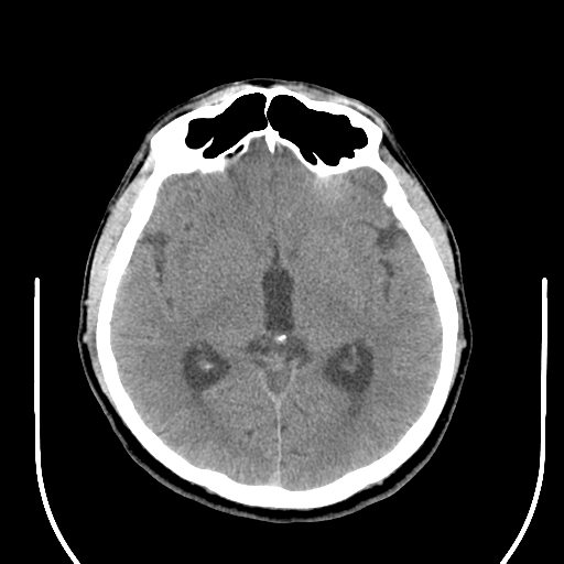 File:Acoustic schwannoma (Radiopaedia 39170-41388 Axial non-contrast 24).png