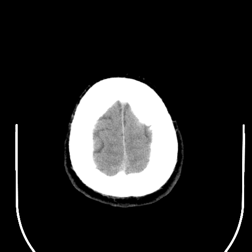 File:Acoustic schwannoma (Radiopaedia 39170-41388 Axial non-contrast 45).png