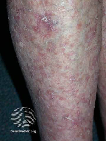 File:Actinic Keratoses affecting the legs and feet (DermNet NZ lesions-ak-legs-566).jpg
