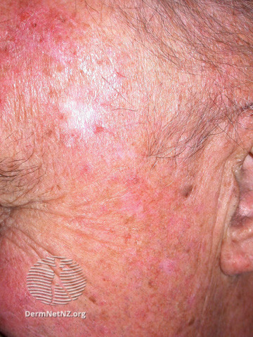 File:Actinic Keratoses treated with imiquimod (DermNet NZ lesions-ak-imiquimod-3764).jpg