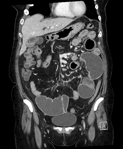 Active Crohn disease (Radiopaedia 59394-66750 Coronal C+ portal venous phase 28).jpg
