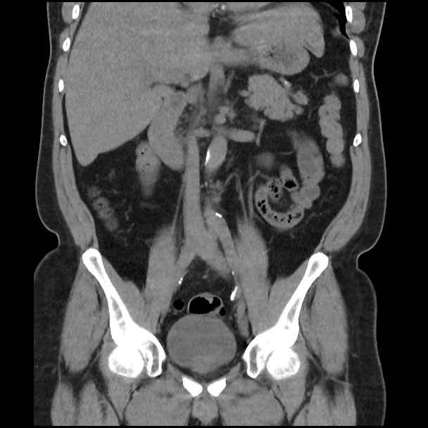Active colonic bleed on CT (Radiopaedia 49765-55025 Coronal non-contrast 29).jpg