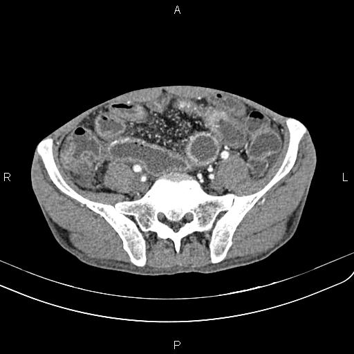 Active crohn disease (Radiopaedia 87133-103397 Axial C+ arterial phase 76).jpg