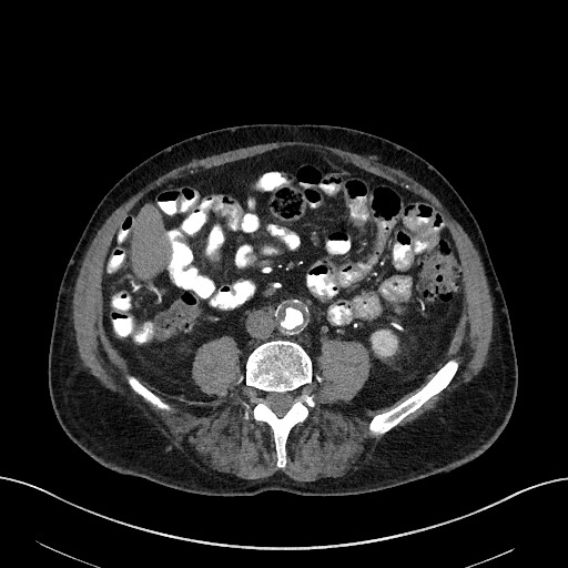 File:Active lower gastrointestinal bleeding - diverticular (Radiopaedia 61203-69106 Axial C+ arterial phase 3).jpg